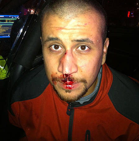 zimmerman broken nose